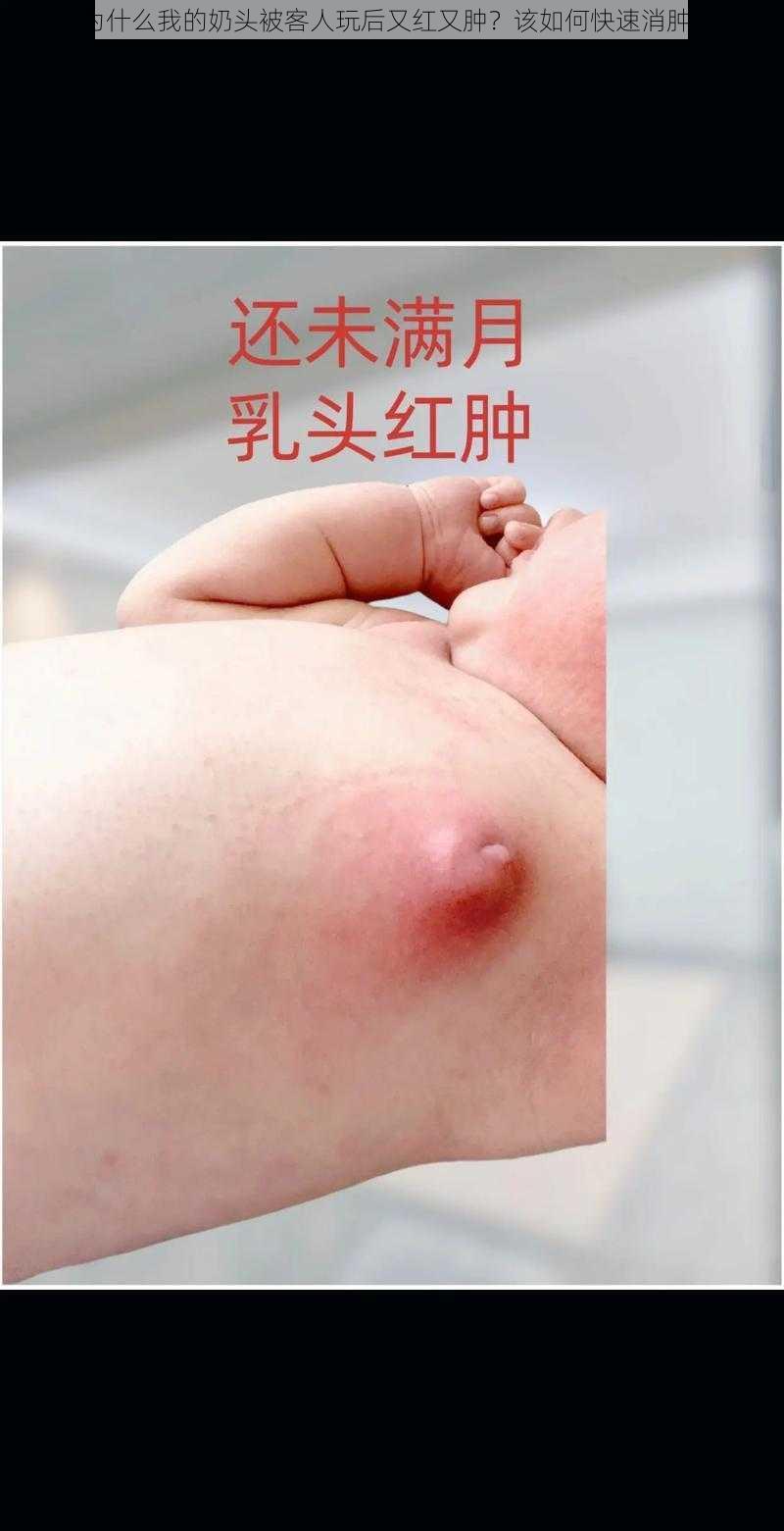 为什么我的奶头被客人玩后又红又肿？该如何快速消肿？